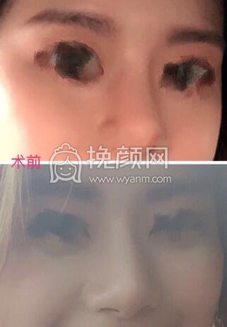 ​​​​我想分享一下我的鼻部手术经历