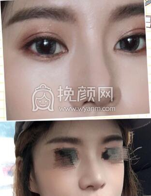​​​​我想分享一下我的鼻部手术经历