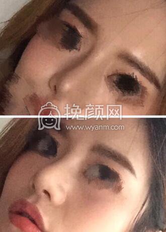 ​​​​我想分享一下我的鼻部手术经历