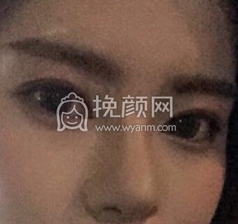 ​​​​我想分享一下我的鼻部手术经历
