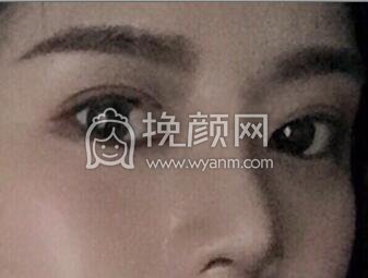 ​​​​我想分享一下我的鼻部手术经历