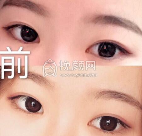 沈阳名流董主任做的全切双眼皮+眼角