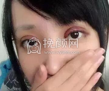 双眼皮手术真实案例~