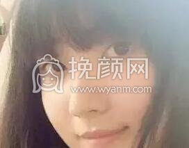 双眼皮手术真实案例~