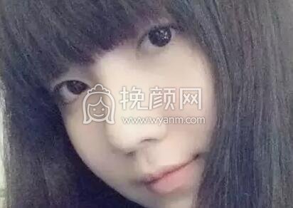 双眼皮手术真实案例~