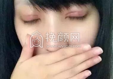 双眼皮手术真实案例~