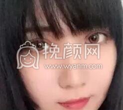 双眼皮手术真实案例~