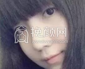 双眼皮手术真实案例~