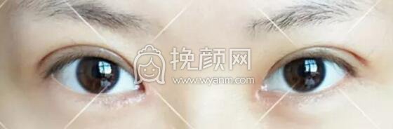 切开双眼皮会不会恢复很慢?