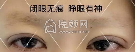 切开双眼皮会不会恢复很慢?