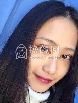天生双眼皮还去割？！是作死吗？