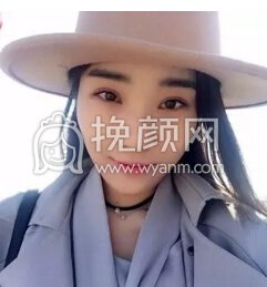 天生双眼皮还去割？！是作死吗？
