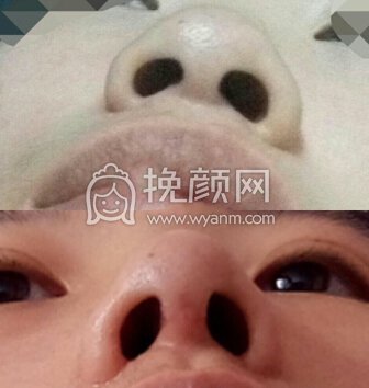 西南医院李喆医生做的鼻部手术