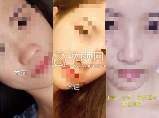 西南医院李喆医生做的鼻部手术