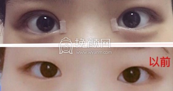 林峰主任做的全切双眼皮+开眼角