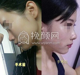 西南医院李喆医生做的鼻部手术