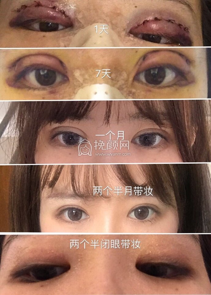 重庆张劲博士做的鼻眼部手术