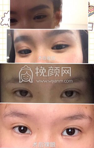 铜雀台徐敦医生做的微创双眼皮、内眼角