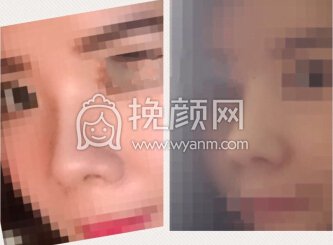 杭州萧山艺之花杨海波医生做的鼻部手术+内眼角