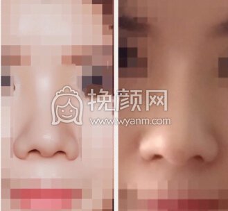 杭州萧山艺之花杨海波医生做的鼻部手术+内眼角