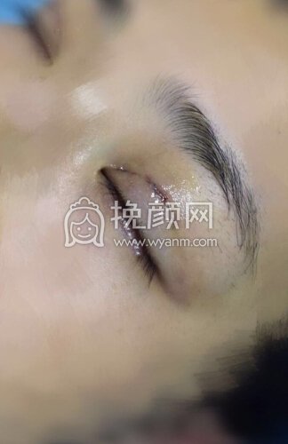 武汉卓美整形找王海平教授做的微创双眼皮