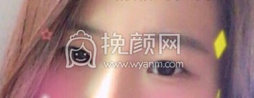 杭州黛雅陆新全切双眼皮