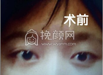 乐山经纬李主任做的全切双眼皮+脂肪填充+提肌
