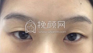 上海曙光医院朱华锋医生全切双眼皮+开眼角