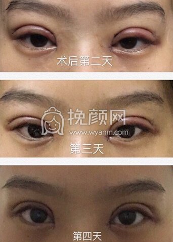上海曙光医院朱华锋医生全切双眼皮+开眼角