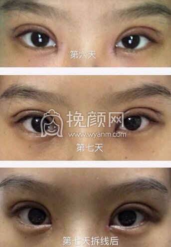 上海曙光医院朱华锋医生全切双眼皮+开眼角