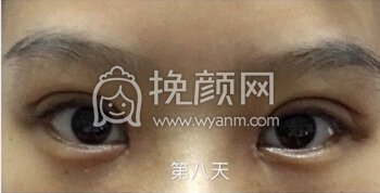 上海曙光医院朱华锋医生全切双眼皮+开眼角