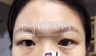 深圳南山医院刘飞医生双眼皮+开眼角+去脂去