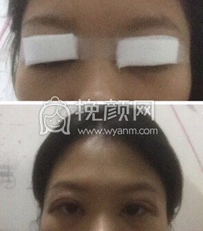 深圳南山医院刘飞医生双眼皮+开眼角+去脂去