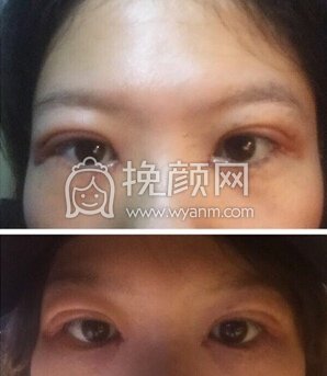 深圳南山医院刘飞医生双眼皮+开眼角+去脂去