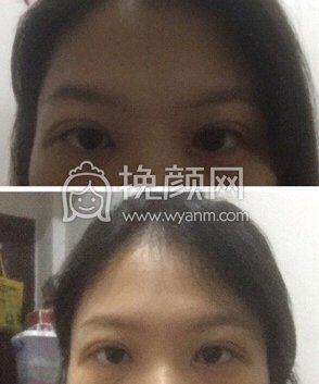 深圳南山医院刘飞医生双眼皮+开眼角+去脂去