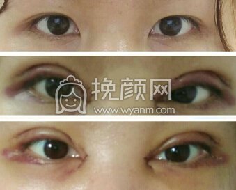 整形医院刘歆全切双眼皮+开眼角+取