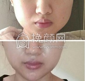 整形医院刘歆全切双眼皮+开眼角+取
