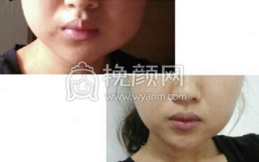 整形医院刘歆全切双眼皮+开眼角+取