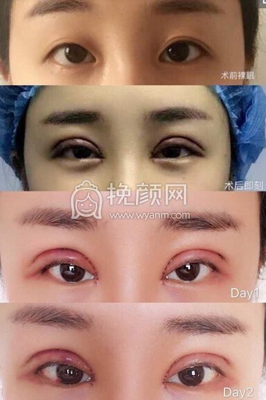 郑州931张鹏医生做的全切双眼皮+开内眼角