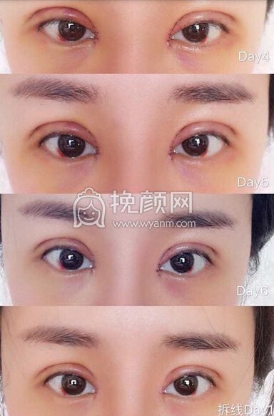 郑州931张鹏医生做的全切双眼皮+开内眼角