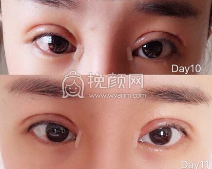 郑州931张鹏医生做的全切双眼皮+开内眼角