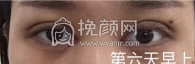 崔劲松(合肥博士整形)陈医生全切双眼皮加开