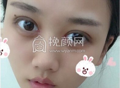 崔劲松(合肥博士整形)陈医生全切双眼皮加开