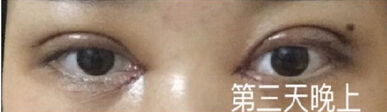崔劲松(合肥博士整形)陈医生全切双眼皮加开