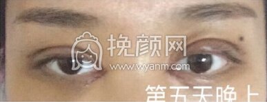 崔劲松(合肥博士整形)陈医生全切双眼皮加开
