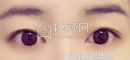 上海九院周一雄医生做的双眼皮