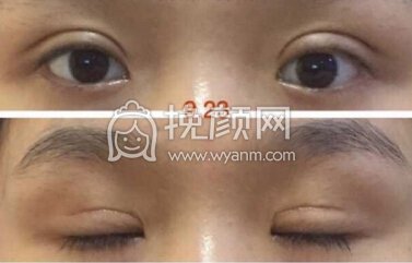 湖南湘西爱尔眼科医院黄院长去了脂肪,全切