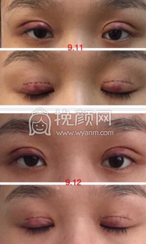 湖南湘西爱尔眼科医院黄院长去了脂肪,全切