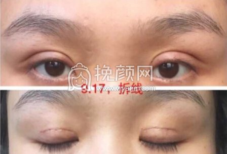 湖南湘西爱尔眼科医院黄院长去了脂肪,全切
