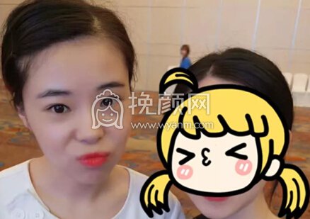 鼻子不好看会毁了整张脸,我就是活生生的例子
